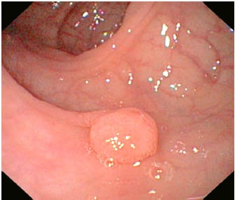 polyp_336