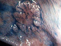 Ранний рак толстой кишки — диаметр поражения 11 мм